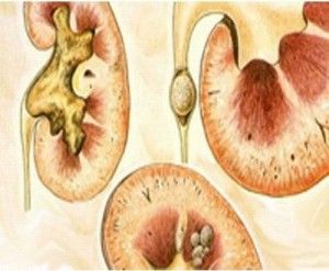 mochekamennaya_bolezn_simptomy_lechenie