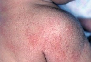 sun-allergy-rash-pictures