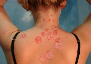 psoriasis_spate