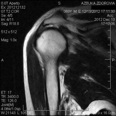 МРТ плечевого сустава