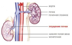 опущение почек