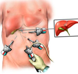 удаление желчного пузыря