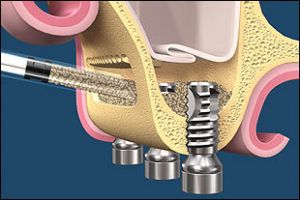 sinus_lifting