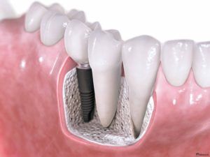 1367050891_dental-implants