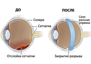 отслойка сетчатки глаза