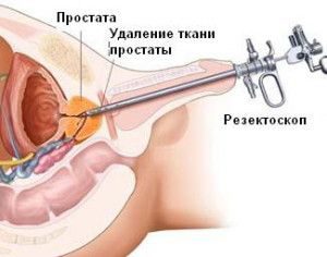 резекция аденомы простаты