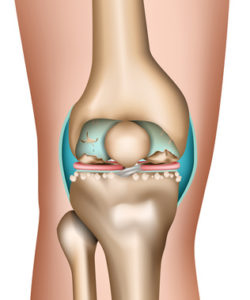 коленный артроз