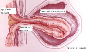 Герниопластика