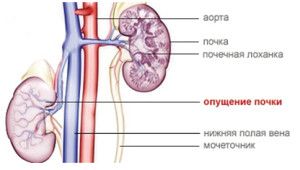 опущение почек