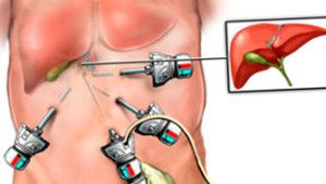 удаление желчного пузыря