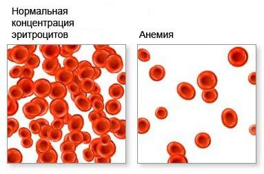 анемия