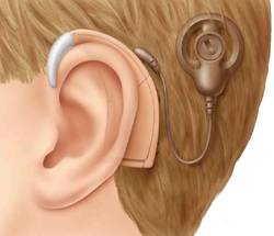 ремонт слуховых аппаратов
