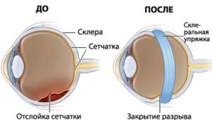 отслойка сетчатки глаза