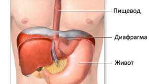 Диафрагмальная грыжа