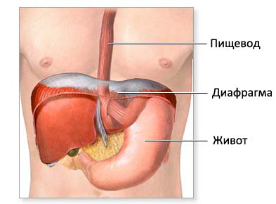 Диафрагмальная грыжа