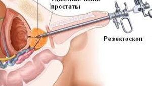 резекция аденомы простаты