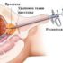 резекция аденомы простаты