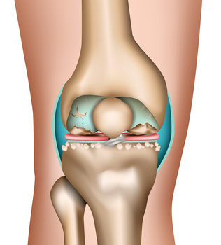 коленный артроз