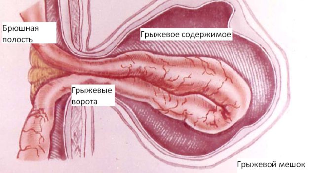 Герниопластика